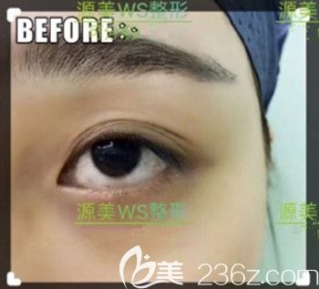 術前眼皮松弛眼睛沒有精神 術前眼皮松弛眼睛沒有精神