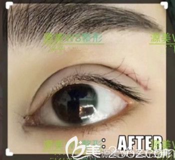 割雙眼皮的時候是否需要開內眼角 割雙眼皮的時候是否需要開內眼角