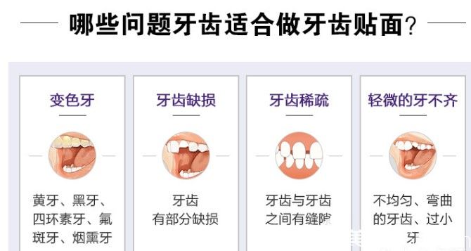 哪些牙齒可以做牙齒貼面