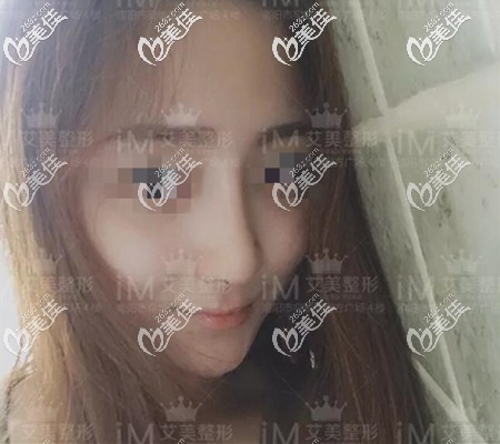 鼻綜合術(shù)后半年恢復(fù)效果