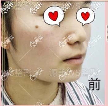 玻尿酸填充下巴前的樣子 玻尿酸填充下巴前的樣子