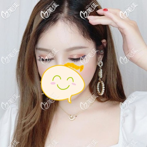 在廣州種完發(fā)際線我特別擔心脫落期不長頭發(fā)，誰知道植發(fā)后四個半月頭發(fā)就開始大量生長了