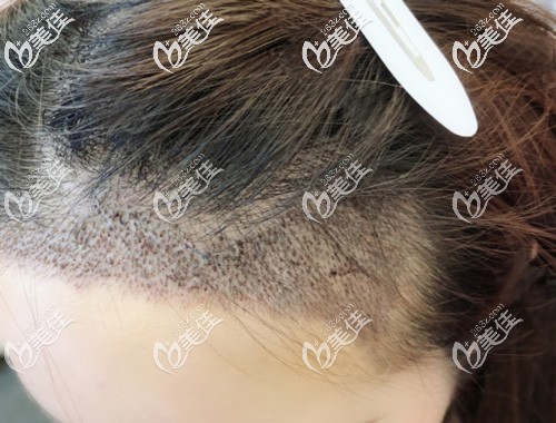 發(fā)際線剛種上去的毛囊