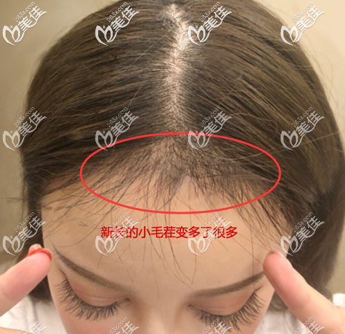 植發(fā)際線4個月后的頭發(fā)長了很多