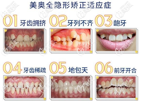 重慶美奧口腔全隱形牙齒矯正