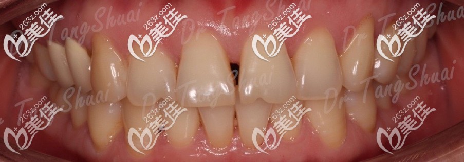 做樹(shù)脂貼面前牙齒的樣子 做樹(shù)脂貼面前牙齒的樣子