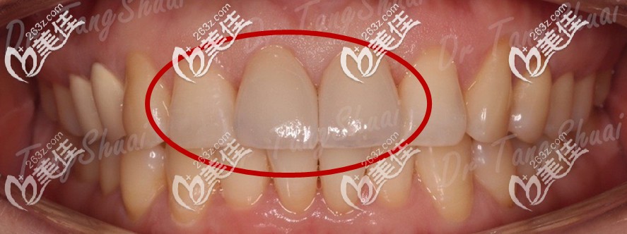 樹(shù)脂貼面過(guò)程圖片 樹(shù)脂貼面過(guò)程圖片