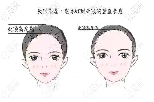 女士發(fā)際線種植設(shè)計(jì)方案 女士發(fā)際線種植設(shè)計(jì)方案