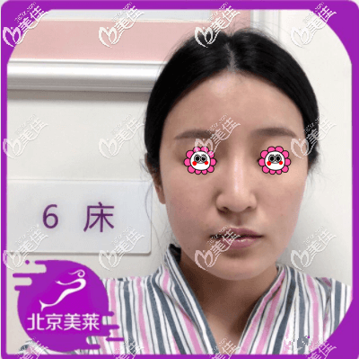 做脂肪豐額頭前樣子 做脂肪豐額頭前樣子