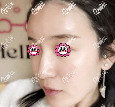 術(shù)后第十天效果 術(shù)后第十天效果