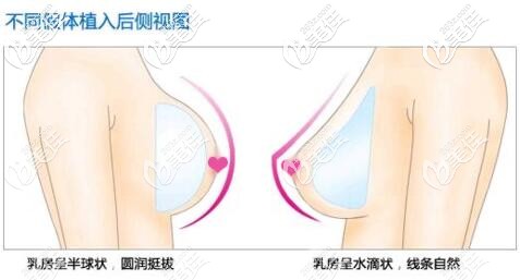 不同形狀隆胸假體材料的側(cè)視展現(xiàn)效果圖 不同形狀隆胸假體材料的側(cè)視展現(xiàn)效果圖