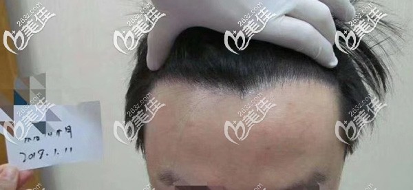 ?額角脫發(fā)恢復(fù)案例:大面積植發(fā)2500毛囊單位后我額角的頭發(fā)再次能長出來