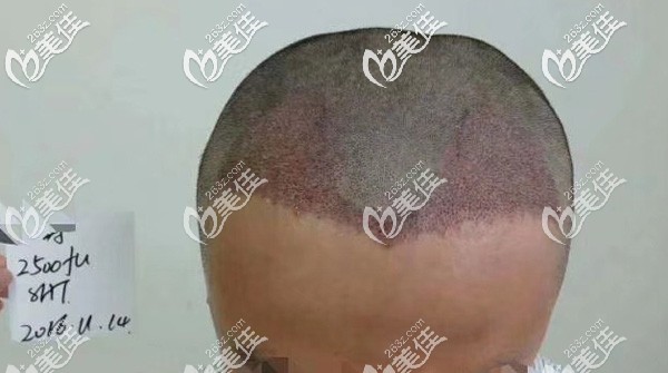 額角植發(fā)2500毛囊單位術(shù)后即刻 額角植發(fā)2500毛囊單位術(shù)后即刻
