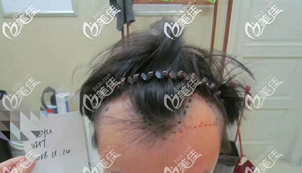16年底我選在<!--<i data=20240703-sp></i>-->做植發(fā)手術(shù) 16年底我選在<!--<i data=20240703-sp></i>-->做植發(fā)手術(shù)
