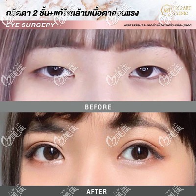 泰國割雙眼皮哪家醫(yī)院好？泰國藝術整形醫(yī)院雙眼皮真人案例圖