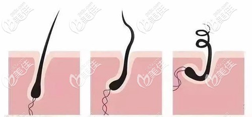 毛囊萎縮、脫發(fā)的演變過(guò)程