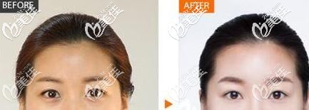 吳金峰雙眼皮案例效果 吳金峰雙眼皮案例效果