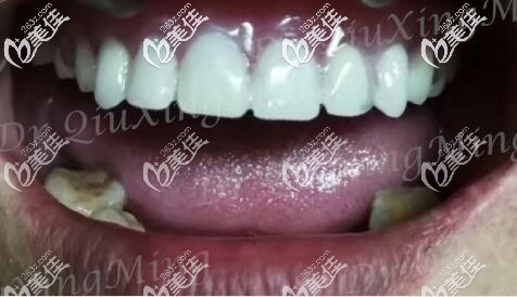 老媽做的上半口allon6瑞士iti親水種植牙這么好,誰能想到曾因牙周炎被朝陽區(qū)多家牙科拒絕