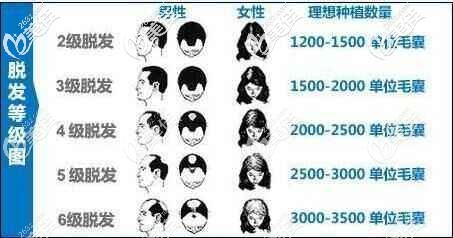 不同等級脫發(fā)所需的毛囊個數(shù) 不同等級脫發(fā)所需的毛囊個數(shù)