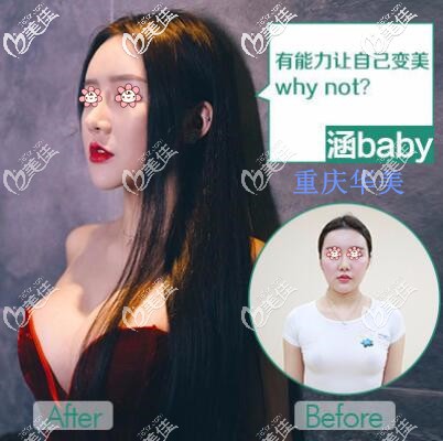 重慶華美陳德法隆胸案例