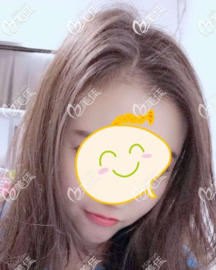 我是在參加植發(fā)觀摩會(huì)了解本院的植發(fā)效果和價(jià)格后，才決定在這做發(fā)際線種植的