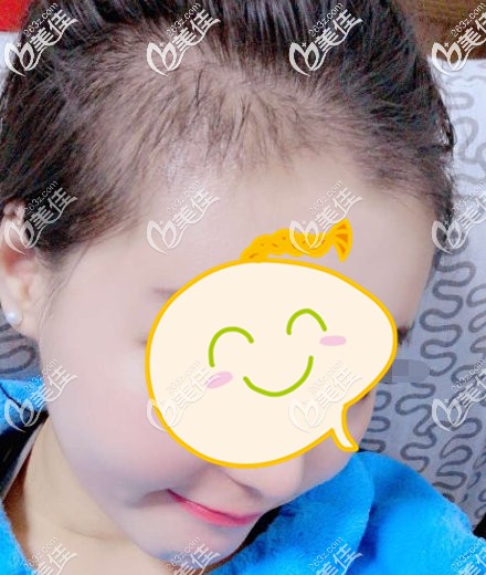 脫落期后發(fā)際線生長(zhǎng)情況