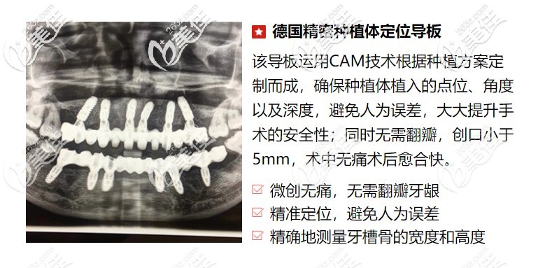 微創(chuàng)種植科的特色技術(shù) 微創(chuàng)種植科的特色技術(shù)