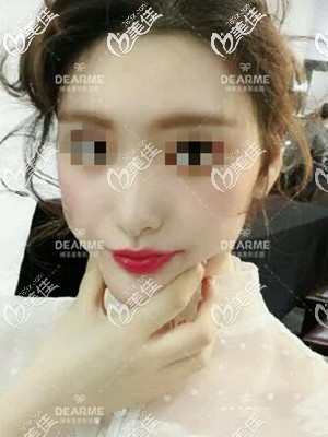 不知道顴骨高是磨骨還是脂肪填充好的戳進來看案例對比照選擇適合你的