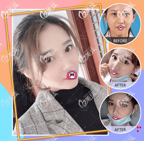 北京美萊醫(yī)生Dallas綜合隆鼻案例