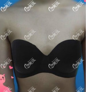 伊思雅假體隆胸術(shù)前 伊思雅假體隆胸術(shù)前