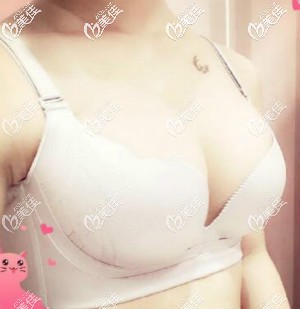 伊思雅假體隆胸術(shù)后效果 伊思雅假體隆胸術(shù)后效果