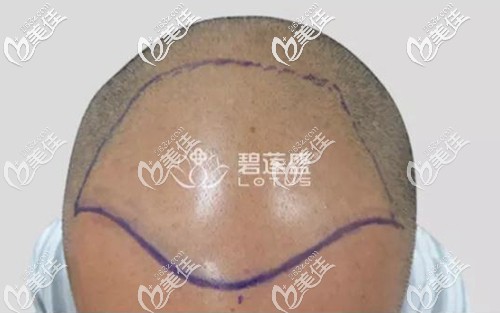 經(jīng)過術(shù)前設(shè)計(jì)，需要植發(fā)的區(qū)域不小