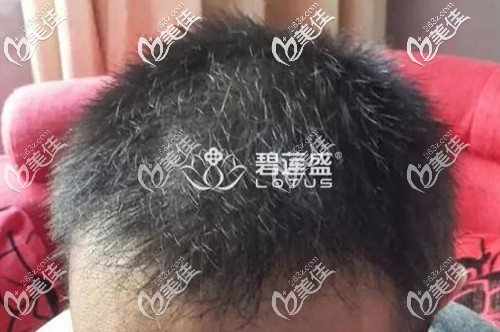 我由于雄性激素脫發(fā)時間較長脫發(fā)等級已達(dá)5級,所以只能靠前額頭頂植發(fā)治療了