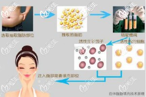 臉部自體脂肪填充技術(shù)原理圖解