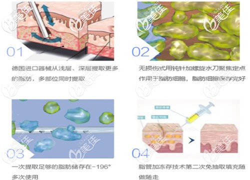 泉州脂管加自體脂肪抽吸過(guò)程圖