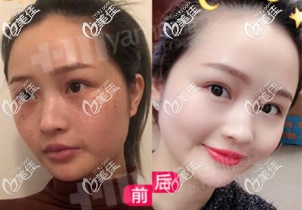 做皮秒激光祛斑術(shù)前術(shù)后對比照 做皮秒激光祛斑術(shù)前術(shù)后對比照