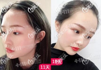 皮秒激光祛斑術(shù)后半個月左右效果照 皮秒激光祛斑術(shù)后半個月左右效果照