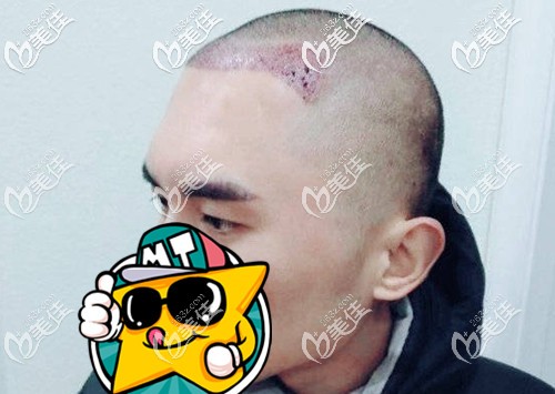 發(fā)際線下調(diào)種植即可效果圖