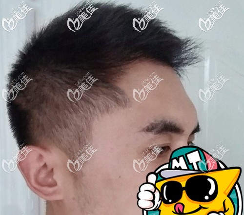 術(shù)后7個(gè)月頭頂長(zhǎng)出了頭發(fā)