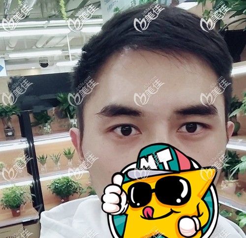 (我22歲男生)腦門禿發(fā)際線上移，做植發(fā)下調(diào)發(fā)際線后不再懼怕露額頭