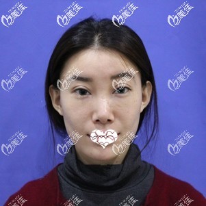 做超皮秒祛黃褐斑術(shù)后一周結(jié)痂 做超皮秒祛黃褐斑術(shù)后一周結(jié)痂