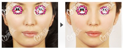 廣比利次醫(yī)生顴骨整形案例