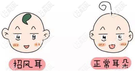 泰國圣卡洛整形醫(yī)院招風耳矯正需要多錢？