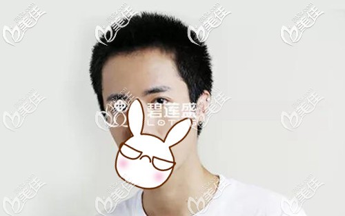 去年我到合肥一家發(fā)際線調(diào)整醫(yī)院，花兩萬多的價錢在前額種植了1500毛囊單位