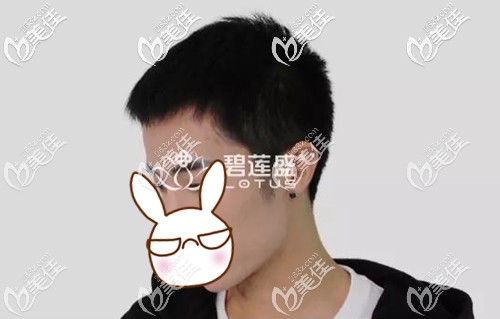 發(fā)際線種植一年效果圖