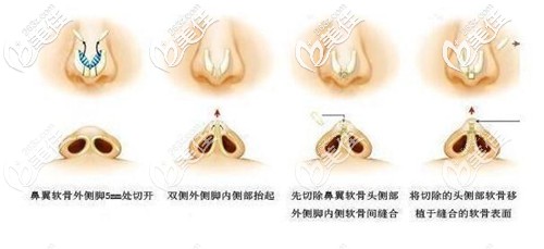 咸福實(shí)醫(yī)生做鼻綜合手術(shù)過程