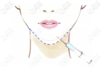 自體脂肪填充下巴手術(shù)原理 自體脂肪填充下巴手術(shù)原理