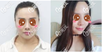 重慶華美下頜角整形真人案例 重慶華美下頜角整形真人案例