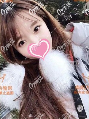 忍不住分享眼間距寬做全切雙眼皮手術+開眼角恢復過程圖的效果