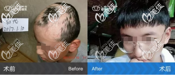 碧蓮盛疤痕修復(fù)種植案例效果圖